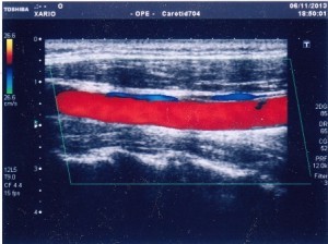 Ecocolordoppler dei Tronchi Sovraortici o Carotideo 2 ecocolordoppler tronchi sovraortici tsa carotideo nomentano