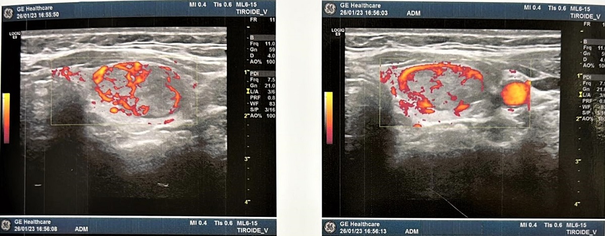 Ecocolordoppler Tiroide Nomentano Monterotondo ecocolordoppler tiroide monterotondo nomentano