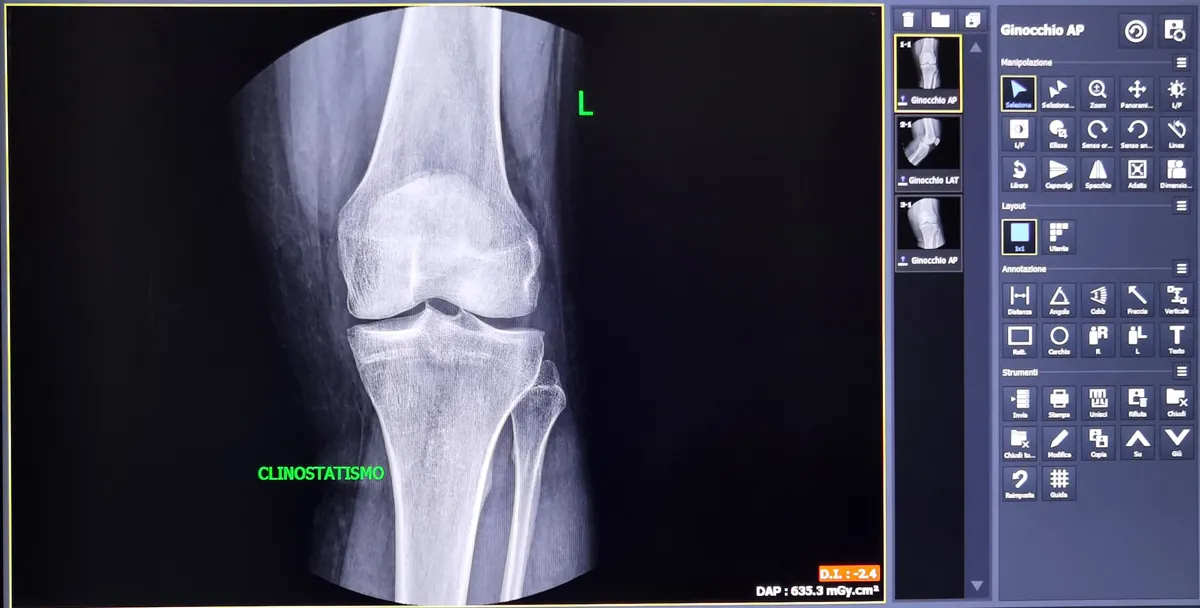 Radiologia-Digitale-Nomentano-Monterotondo-Ginocchio_11zon radiologia nomentano monterotondo