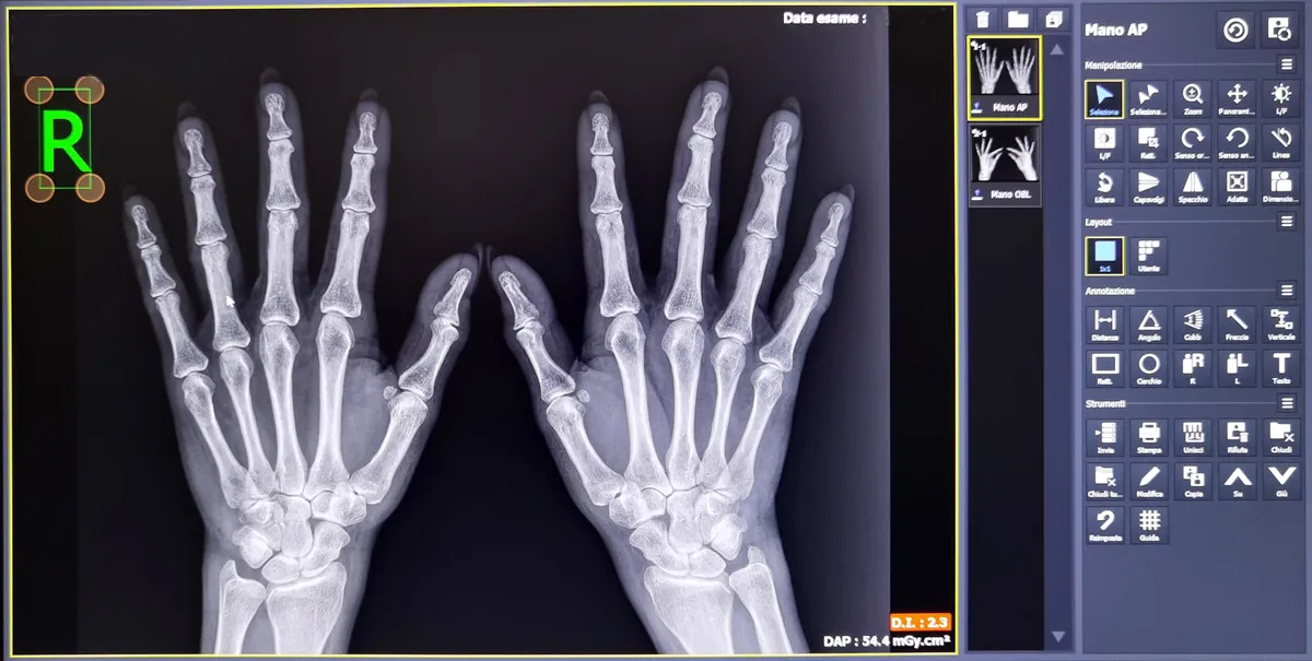 Radiologia-Digitale-Nomentano-Monterotondo-Mani_11zon lastre radiologia monterotondo nomentano