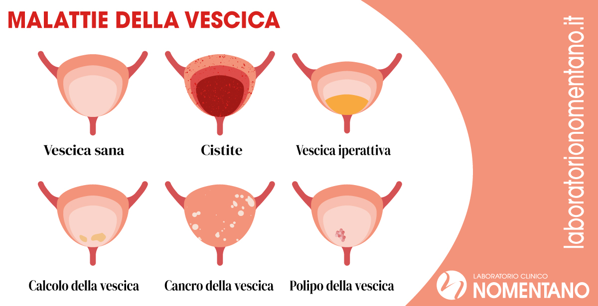 MALATTIE-DELLA-VESCICA-INFOGRAFICA vescica