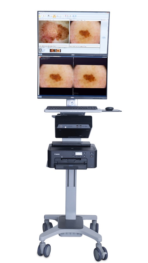 mappatura nei, dermatoscopia, epiluminescenza, dermalview,